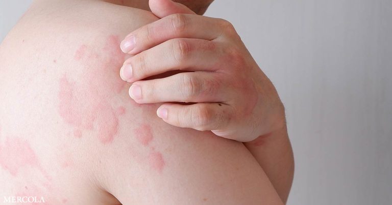 Is Histamine to Blame for Your Headache, Hives and Heartburn?